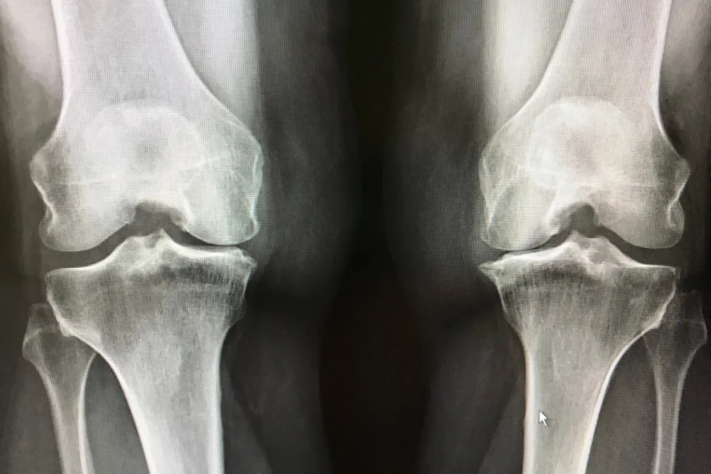 can-your-knee-be-preserved
