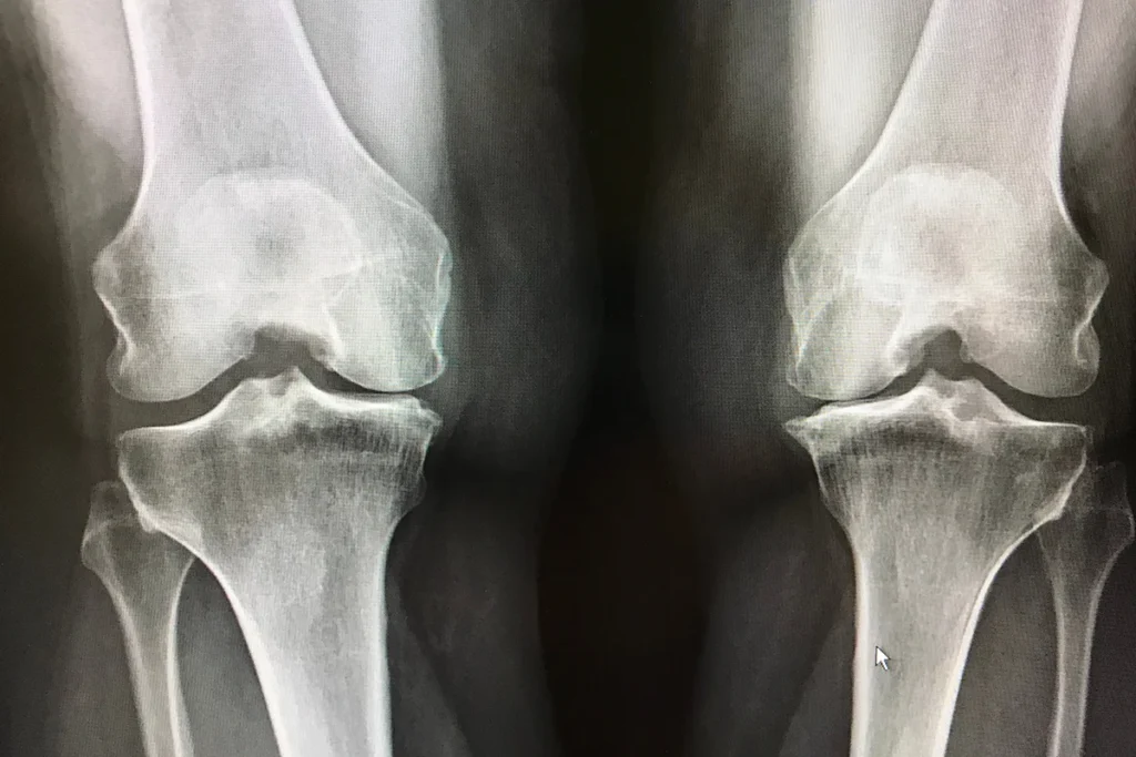 How a Stem Cell Injection in the Knee Works Biologically