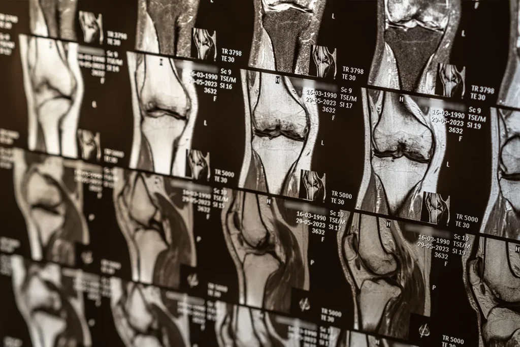 Will stem cells regrow knee cartilage